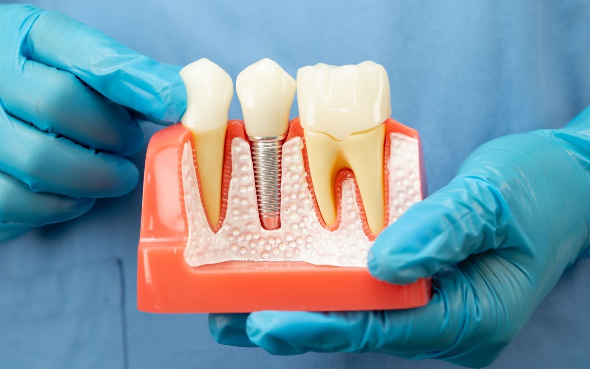 Dental Implant vs Bridge vs Partial Denture: Which Fits Your Needs Best?