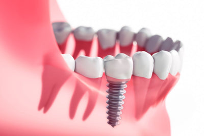 dental implants representaion