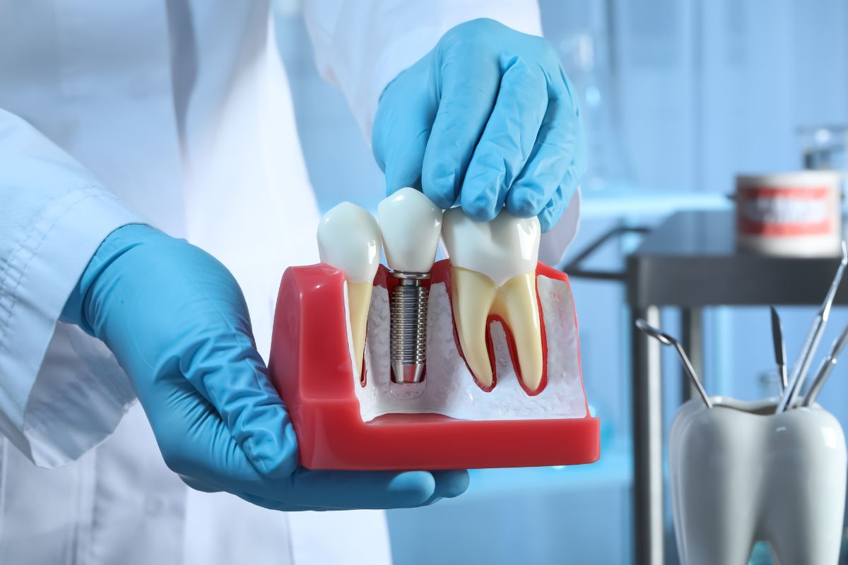 Dental Bridges or Dental Implants - Which One Should You Choose?