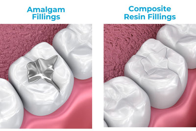 Why Choose Composite Resin Fillings Over Amalgam