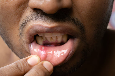 Canker Sores After Tooth Extraction: Causes and Remedies
