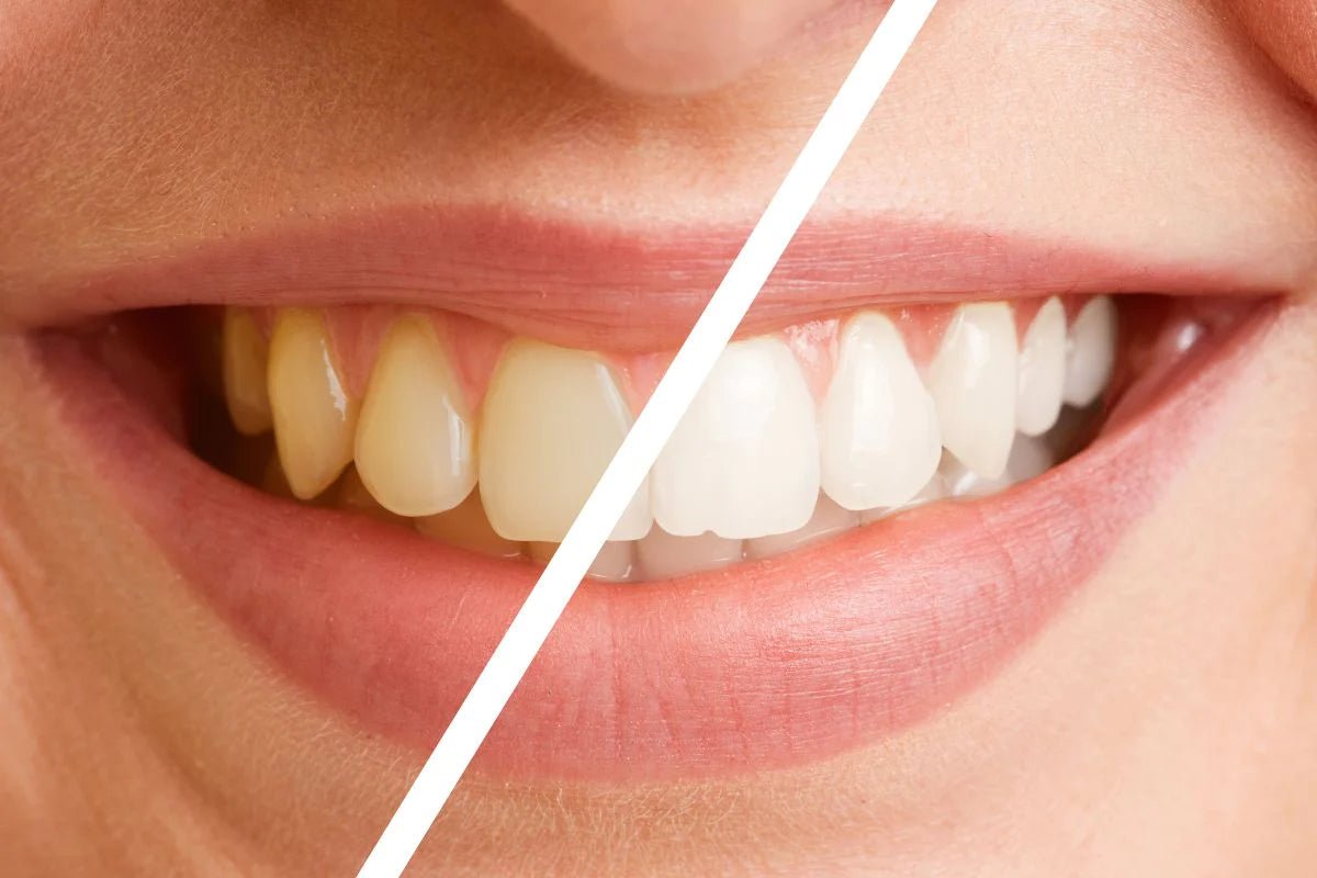 Laser Whitening vs. Zoom Whitening – Your Complete Guide