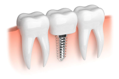 dental implants visualization