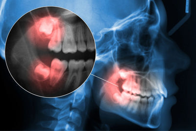 wisdom tooth x-ray