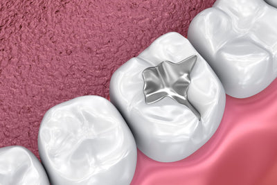 dental fillings silver