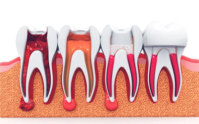 root-canal-img1